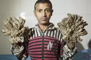 Begini keadaan manusia 'Tangan Kayu' usai jalani operasi berkali-kali