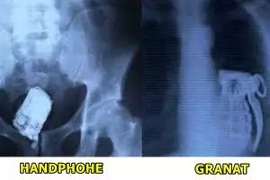 15 Benda aneh yang pernah tertangkap X-Ray dari tubuh manusia, ngeri