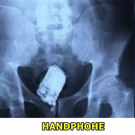 15 Benda aneh yang pernah tertangkap X-Ray dari tubuh manusia, ngeri