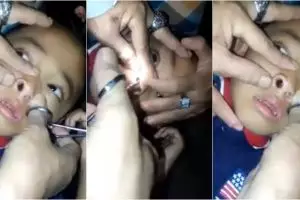 Seekor lintah tak diduga hidup di hidung anak ini, ngeri banget