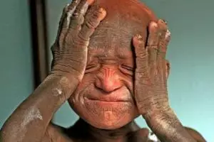 Miris, bocah ini perlahan berubah jadi 'batu' karena penyakit langka