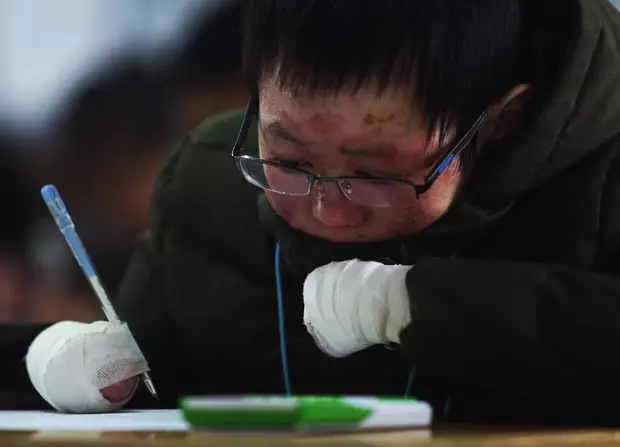 Mei Xiao penyakit  epidermolysis bullosa © 2017 dailystar.co.uk