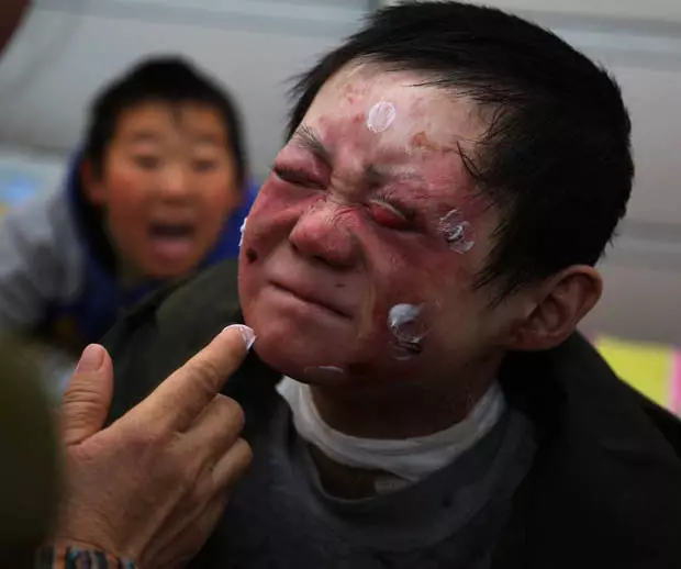 Mei Xiao penyakit  epidermolysis bullosa © 2017 dailystar.co.uk