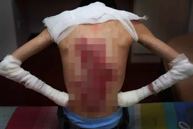 Mei Xiao penyakit  epidermolysis bullosa © 2017 dailystar.co.uk