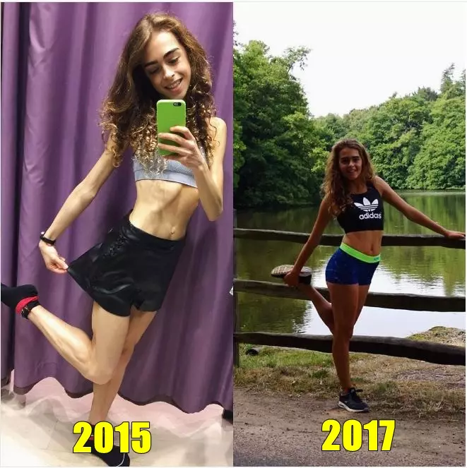 13 Potret pemulihan anoreksia ini bukti sehat lebih penting dari diet