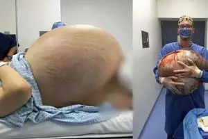 12 Foto ini tunjukan proses operasi kista sebesar 33 kg, menegangkan!