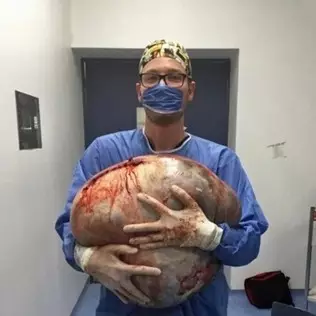 12 Foto ini tunjukan proses operasi kista sebesar 33 kg, menegangkan!