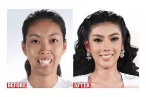 Cewek ini permak gigi dan oplas, hasilnya bikin takjub