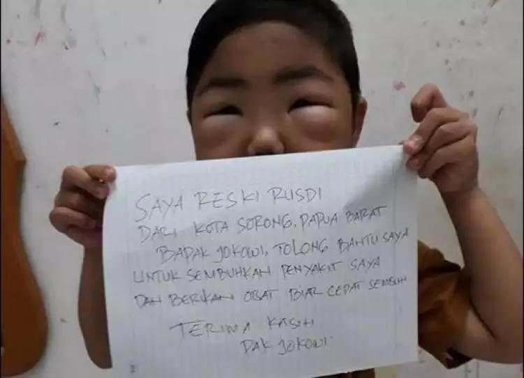 Idap sindrom nefrotik, bocah ini bikin video untuk Presiden Jokowi