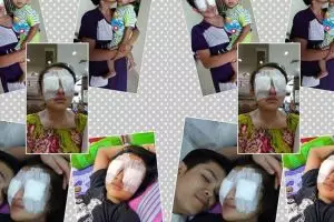 Kisah tragis akibat softlens, mata wanita ini hampir alami kebutaan