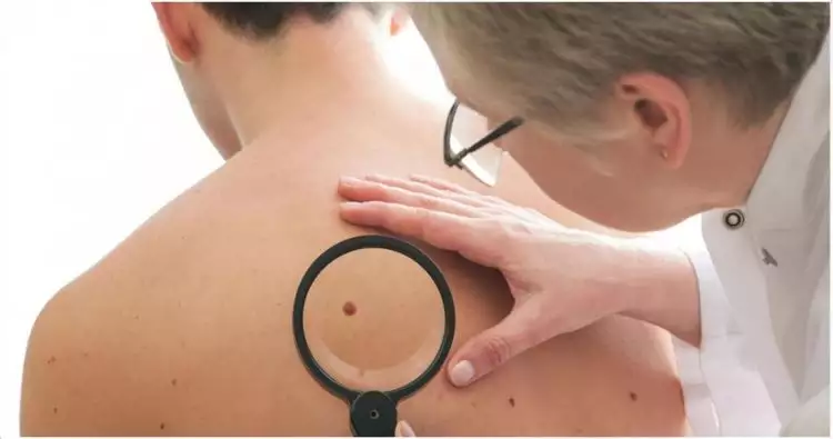 7 Tanda awal penyakit kanker kulit yang sebaiknya kamu ketahui