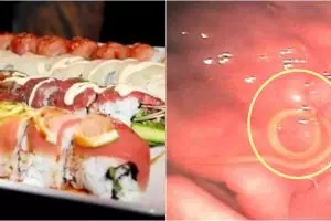 Parasit bersarang di perut pria ini usai menyantap sushi