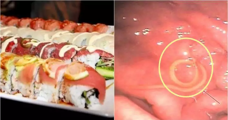 Parasit bersarang di perut pria ini usai menyantap sushi