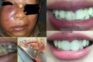 7 Foto mengerikan akibat perawatan gigi di praktik ilegal, serem lho 