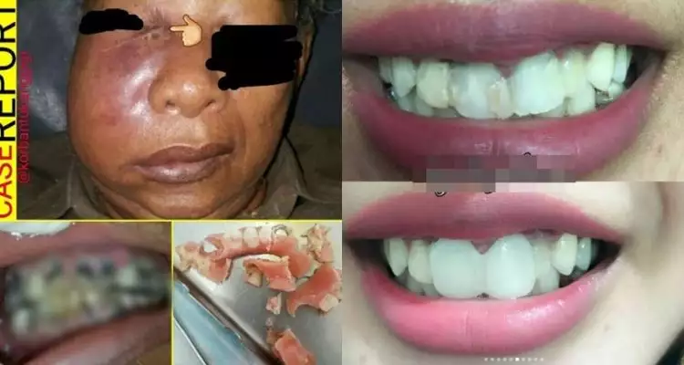 7 Foto mengerikan akibat perawatan gigi di praktik ilegal, serem lho 