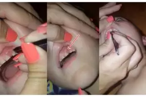 Bukan makanan, benda yang dikeluarkan dari gusi bocah ini bikin kaget