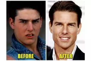 25 Foto before-after hasil pakai behel, jadi PD buat senyum nih