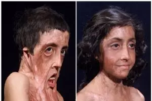 6 Foto before-after transplantasi wajah ini bukti canggihnya medis