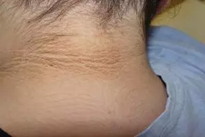 Cara alami berantas bercak hitam di lipatan leher, dijamin ampuh