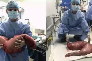 Pria ini sembelit bertahun-tahun, ternyata ada 13 kg tinja di ususnya