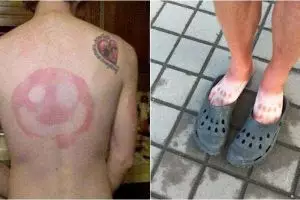 10 Pola kulit belang akibat terbakar sinar matahari ini kocak