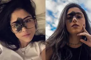 Dibully karena tanda lahir di wajah, cewek ini malah merasa cantik