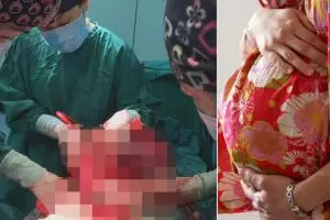 Dikira buncit biasa, wanita ini ternyata 'mengandung' penyakit kronis