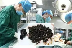 Dokter temukan 200 batu dalam tubuh wanita ini, ada yang sebesar telur