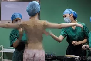 Salah dokter, hasil oplas payudara wanita ini malah jadi mengerikan