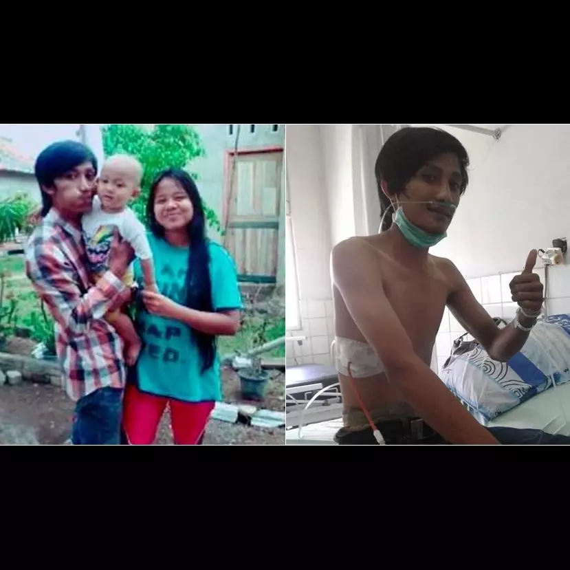 Paru-paru suami harus dibor karena rokok, wanita ini curahkan isi hati