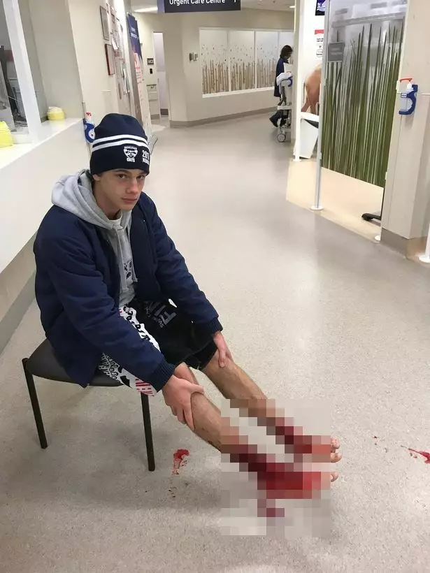 Kaki cowok ini pendarahan, ternyata 'kutu' misterius menggerogotinya