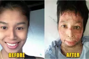 Gara-gara selfie, tubuh wanita ini dibakar suaminya yang cemburu buta