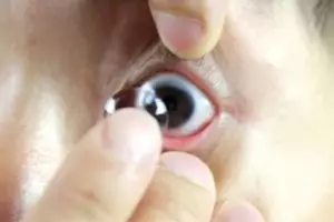 Lupa lepas softlens selama 5 bulan, mata wanita ini alami kebutaan