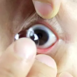 Lupa lepas softlens selama 5 bulan, mata wanita ini alami kebutaan