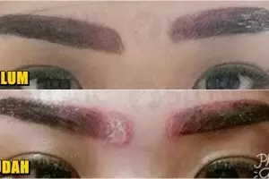 Ingin cantik dengan sulam alis, wanita ini malah luka mengerikan