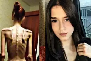 Dulu hanya 'kulit dan tulang', transformasi gadis ini bikin takjub