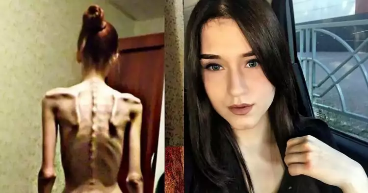 Dulu hanya 'kulit dan tulang', transformasi gadis ini bikin takjub