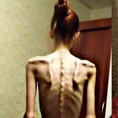 Dulu hanya 'kulit dan tulang', transformasi gadis ini bikin takjub