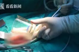 Dokter temukan gelas kaca di dalam pantat pria, alasannya bikin syok