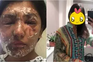 Wajah kena air keras, perubahan cewek ini usai operasi bikin takjub