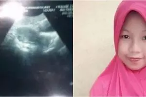 Curhatan pilu wanita yang rahimnya terinfeksi usai suntik KB 3 bulan
