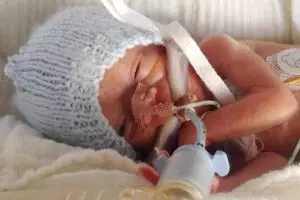 Terlahir seberat 0,5 kg, setelah 4 tahun kondisi bayi ini bikin takjub