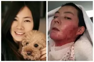 Kisah tragis wanita yang disiram alkohol & dibakar suaminya