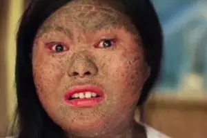 Derita penyakit langka, gadis ini miliki kulit bersisik seperti ular