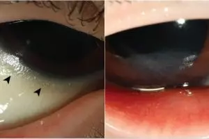 Jalani diet ketat, bocah ini alami kebutaan sebab kekurangan vitamin A