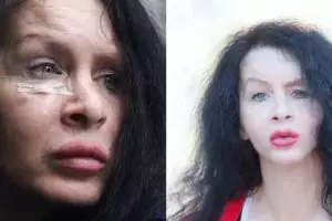 10 Perubahan cewek yang disuntik bakteri langka, tampak lebih muda?