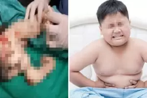 Sering mengeluh sakit perut, dokter temukan janin di tubuh bocah ini