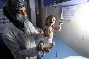 4 Potret bayi gizi buruk akibat perang ini bikin hatimu teriris