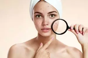 7 Cara ampuh hilangkan bekas jerawat dalam 1 hari, yuk buktikan