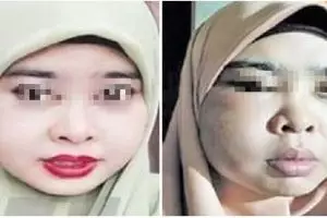 Pakai produk kecantikan yang dibeli online, wajah wanita ini bengkak 